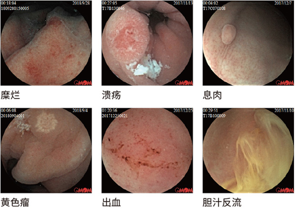 "慧图"磁控胶囊内镜系统